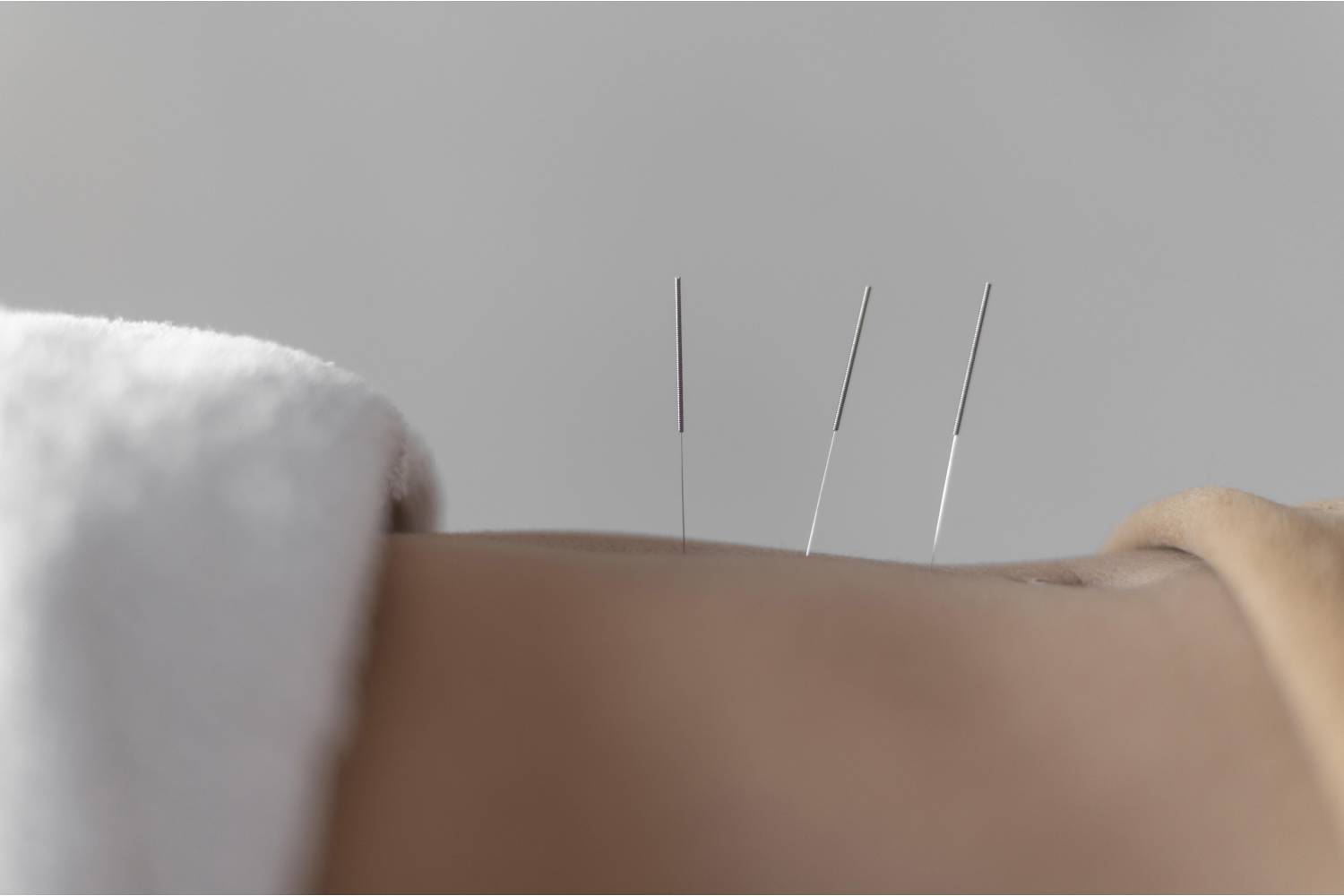 Qual a relação da acupuntura com a fisioterapia?