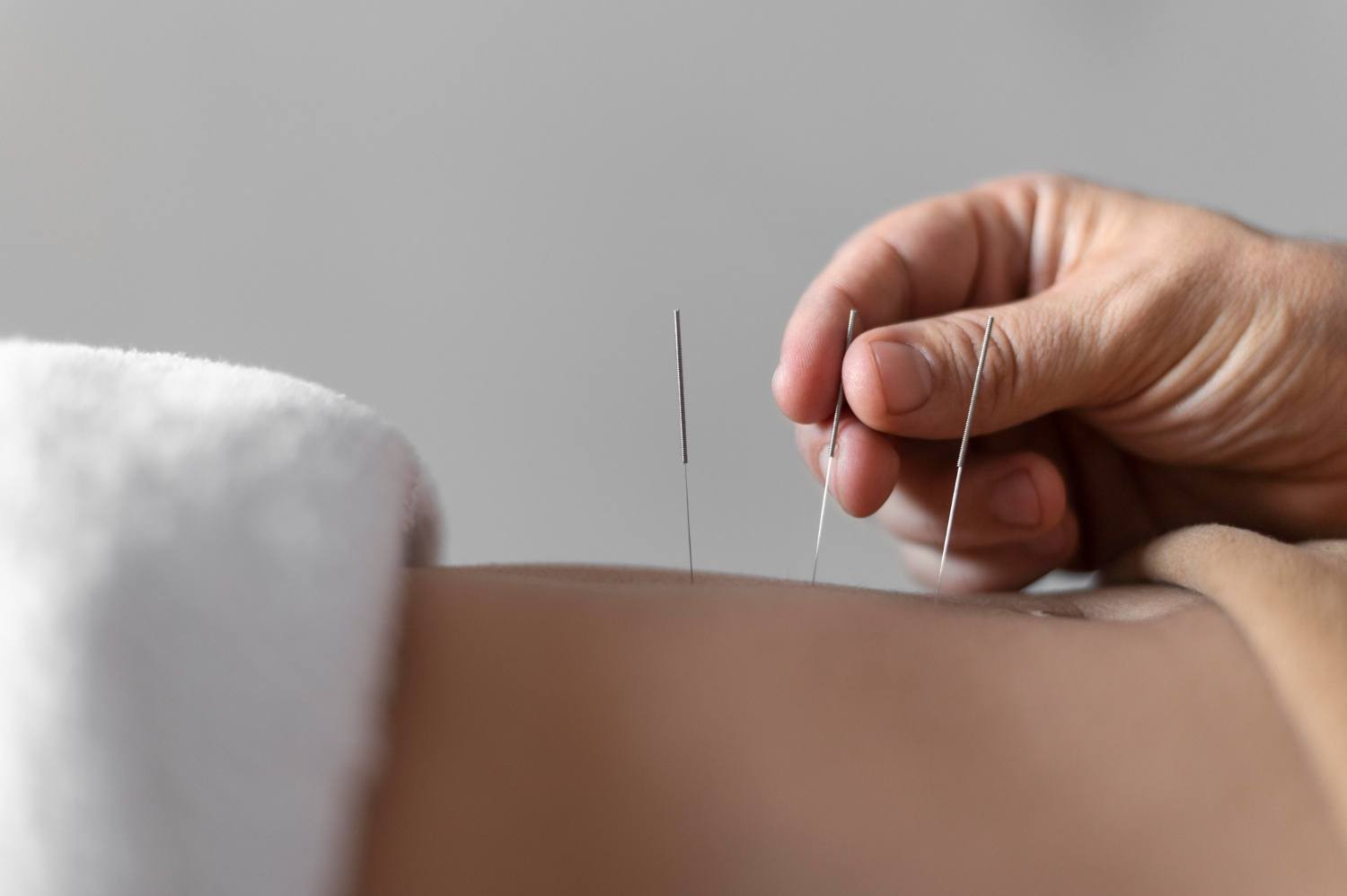 Benefícios da acupuntura para ansiedade