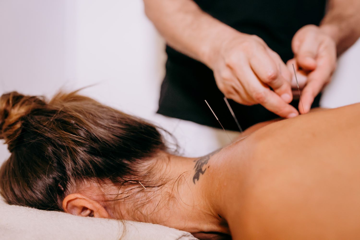 o que é acupuntura?