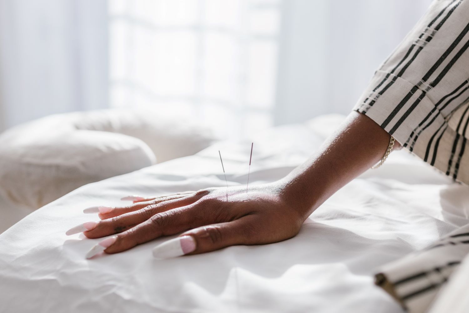 Aplicação de acupuntura na mão e costas, mitos e verdades da acupuntura